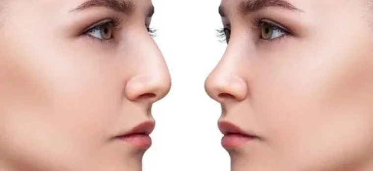 BURUN ESTETİĞİ İLE İLGİLİ EN ÇOK MERAK EDİLEN 12 SORU!