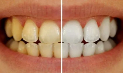 DİŞ BEYAZLATMAYLA İLGİLİ DOĞRU BİLİNEN YANLIŞLAR